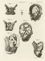 Obstétrique, illustration de 